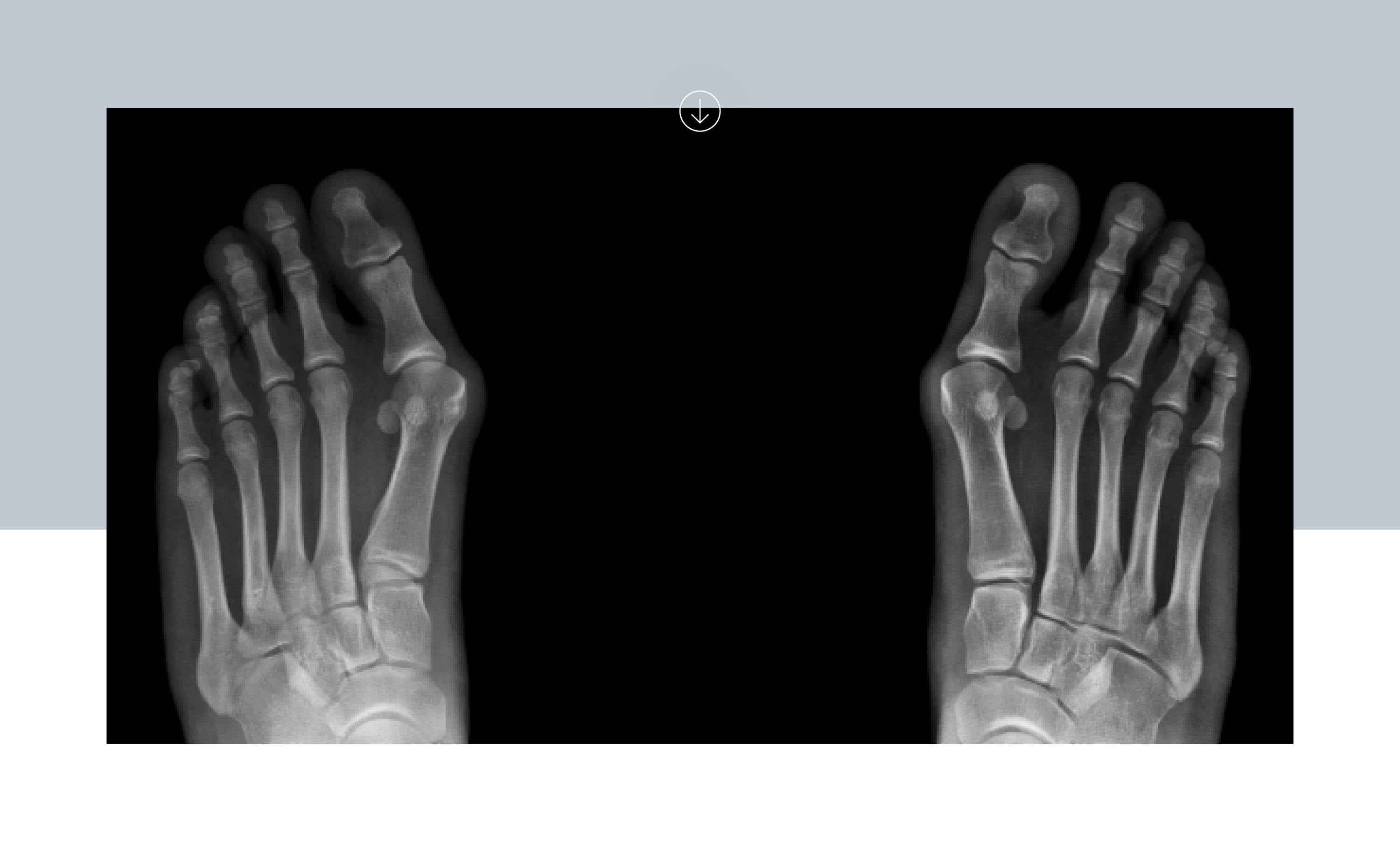 Behind the design: Our unique features for Bunion sufferers